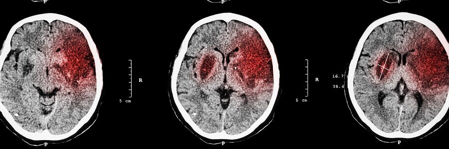 MRI of a stroke patient