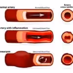 Cross section illustration of inflamed artery wall with plaque buildup linked to blood pressure and cardiovascular disease risk
