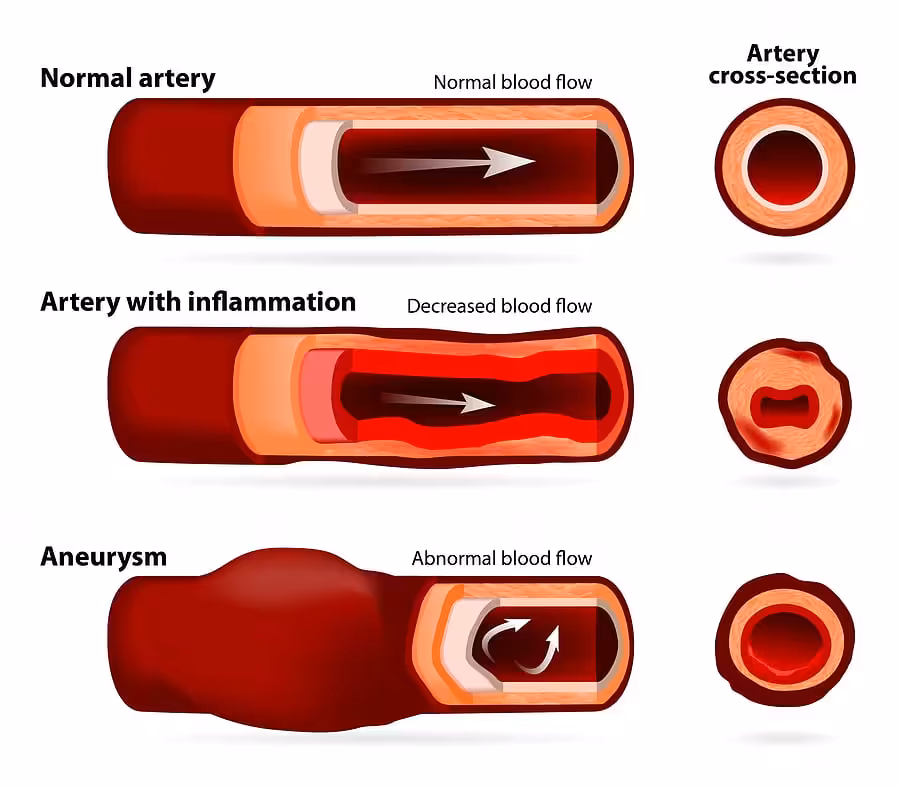 Cross section illustration of inflamed artery wall with plaque buildup linked to blood pressure and cardiovascular disease risk